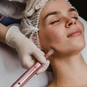 Microneedling RF