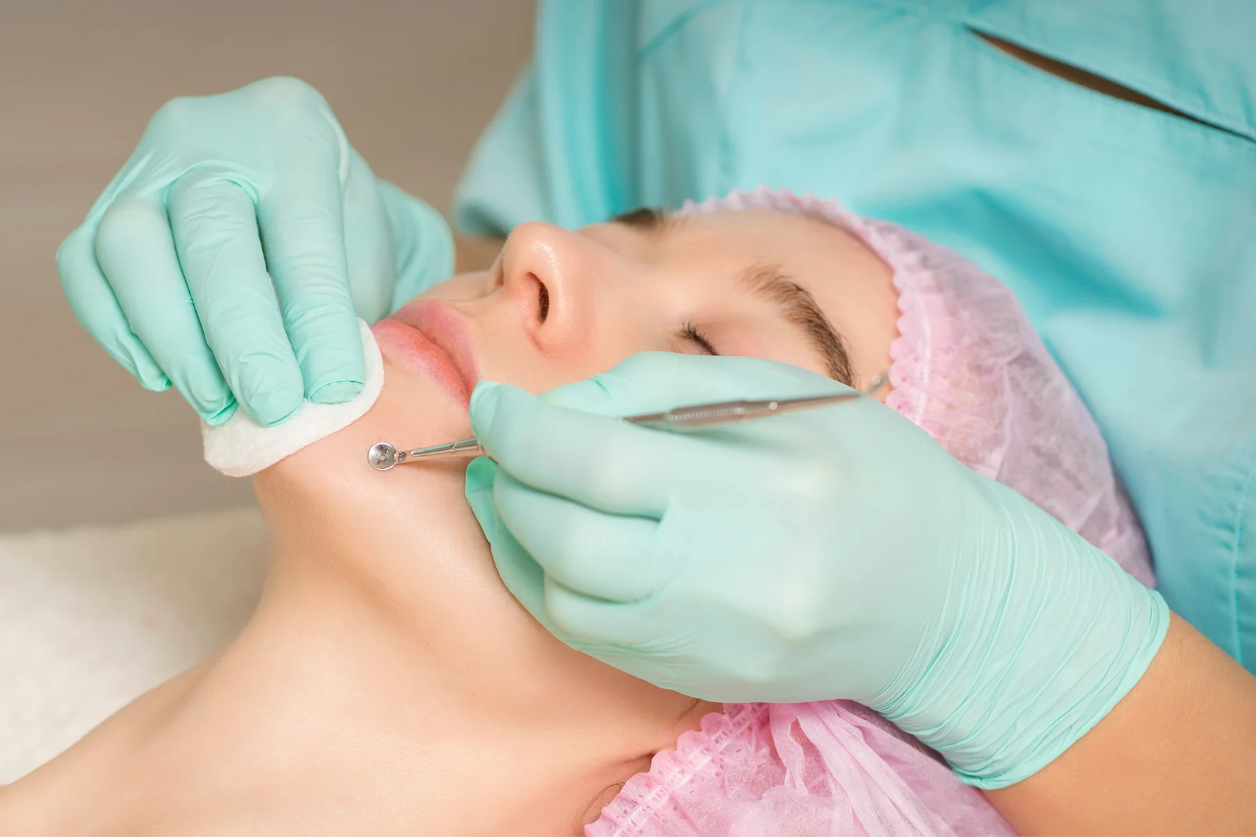Blackhead Removal Treatment- - Lumera Skin Clinique